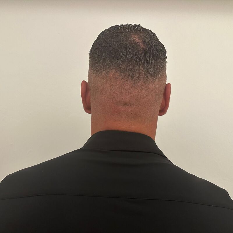 Micheal van der Plas baard en herstel haartransplantatie