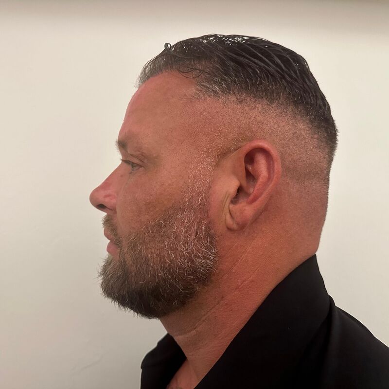 Micheal van der Plas baard en herstel haartransplantatie