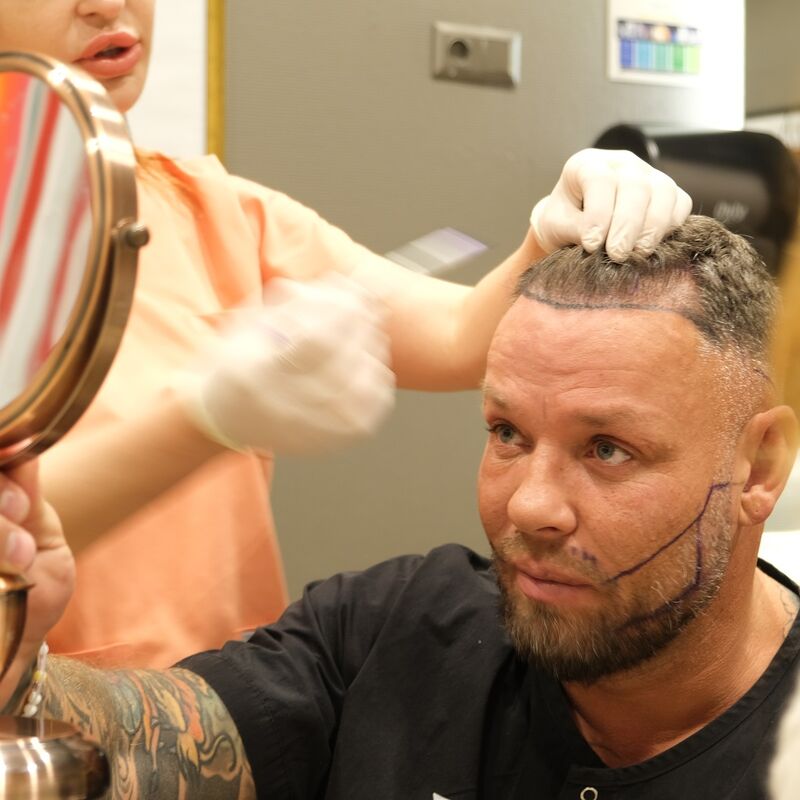 Micheal van der Plas baard en herstel haartransplantatie
