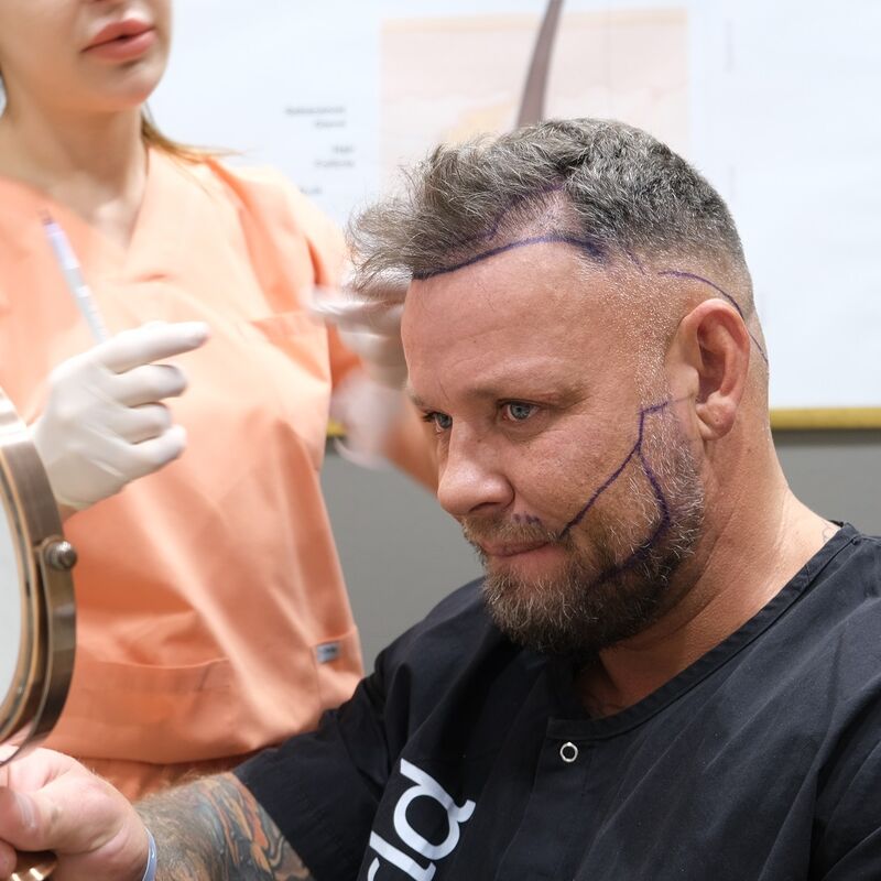 Micheal van der Plas baard en herstel haartransplantatie