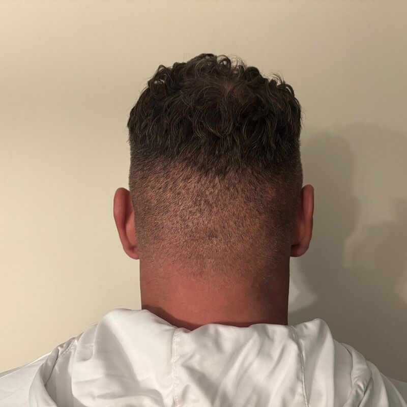 Micheal van der Plas baard en herstel haartransplantatie