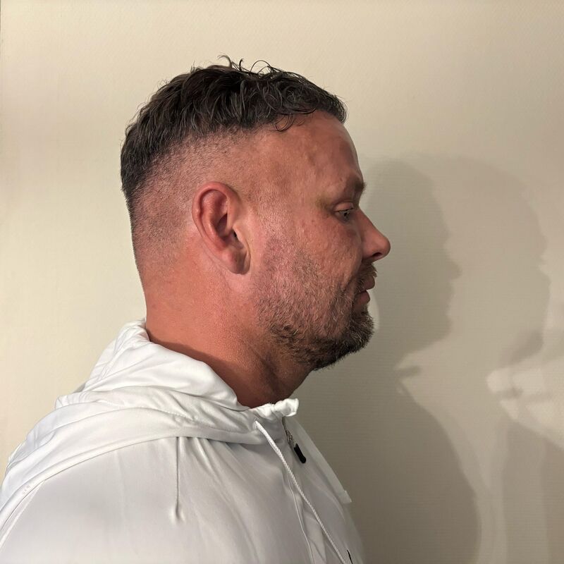 Micheal van der Plas baard en herstel haartransplantatie