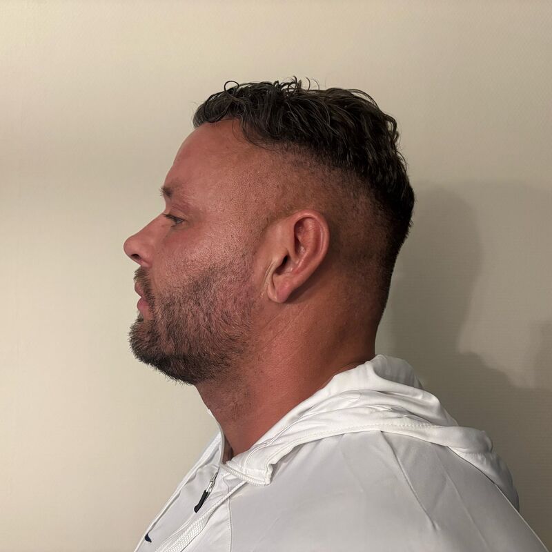 Micheal van der Plas baard en herstel haartransplantatie