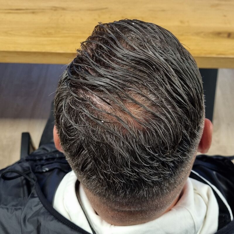 Micheal van der Plas baard en herstel haartransplantatie