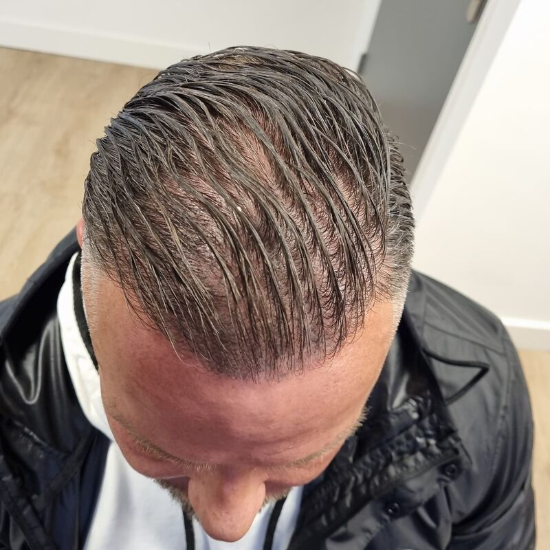 Micheal van der Plas baard en herstel haartransplantatie