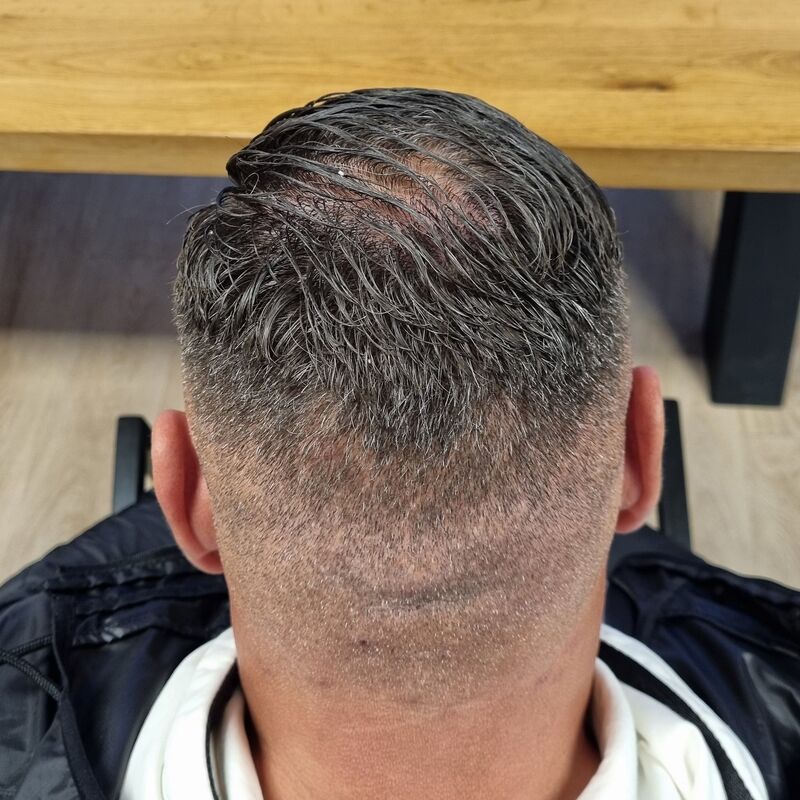 Micheal van der Plas baard en herstel haartransplantatie