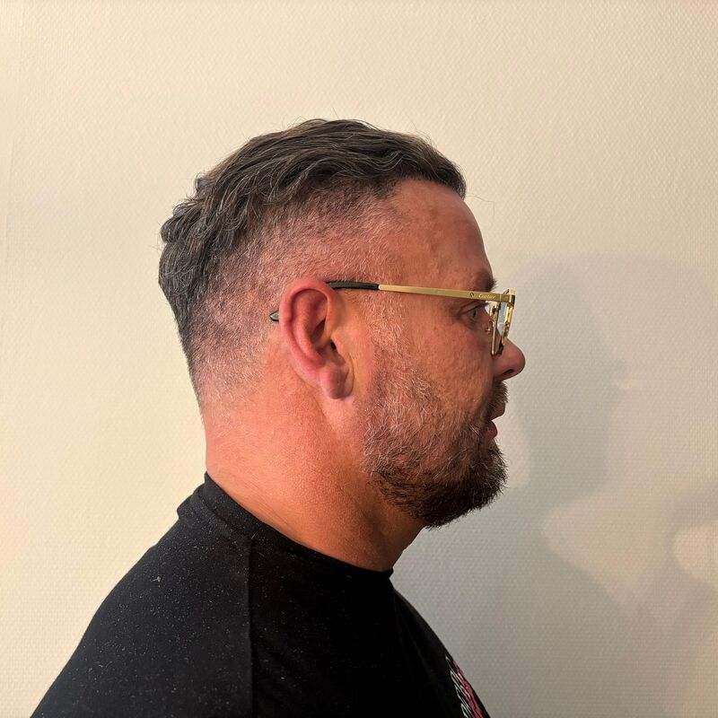 Micheal van der Plas baard en herstel haartransplantatie