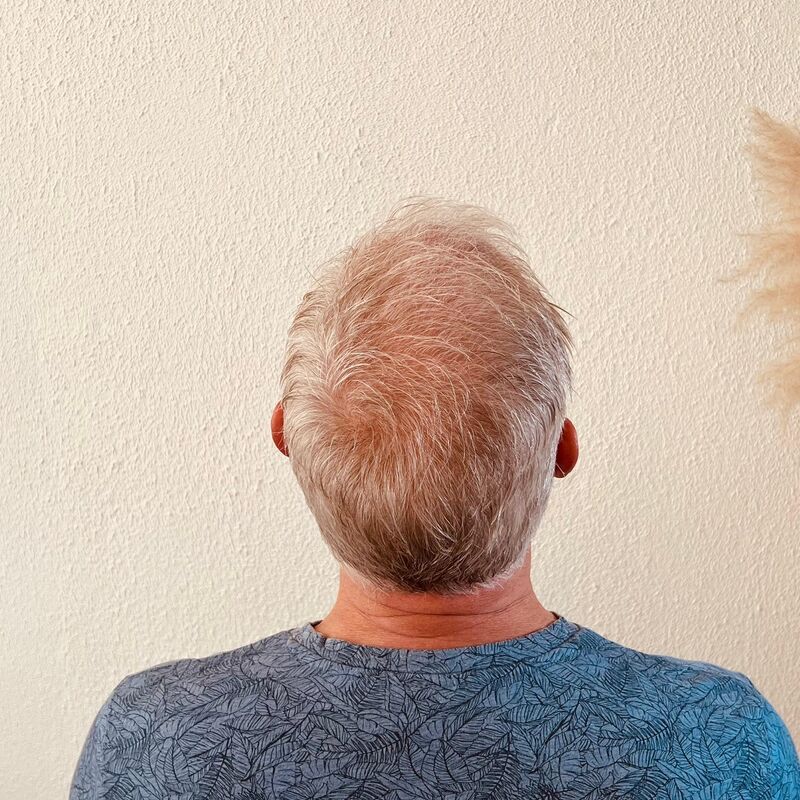 Haartransplantatie ook voor mensen boven de 60