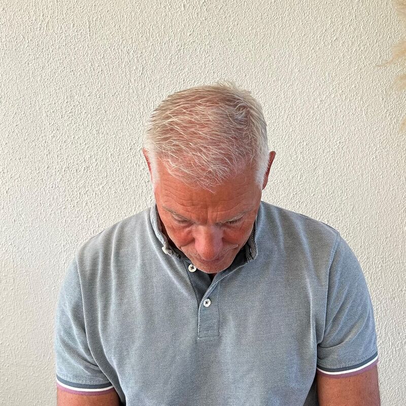 Haartransplantatie ook voor mensen boven de 60