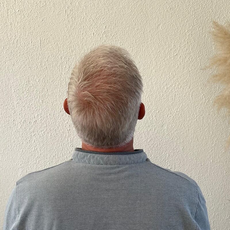 Haartransplantatie ook voor mensen boven de 60