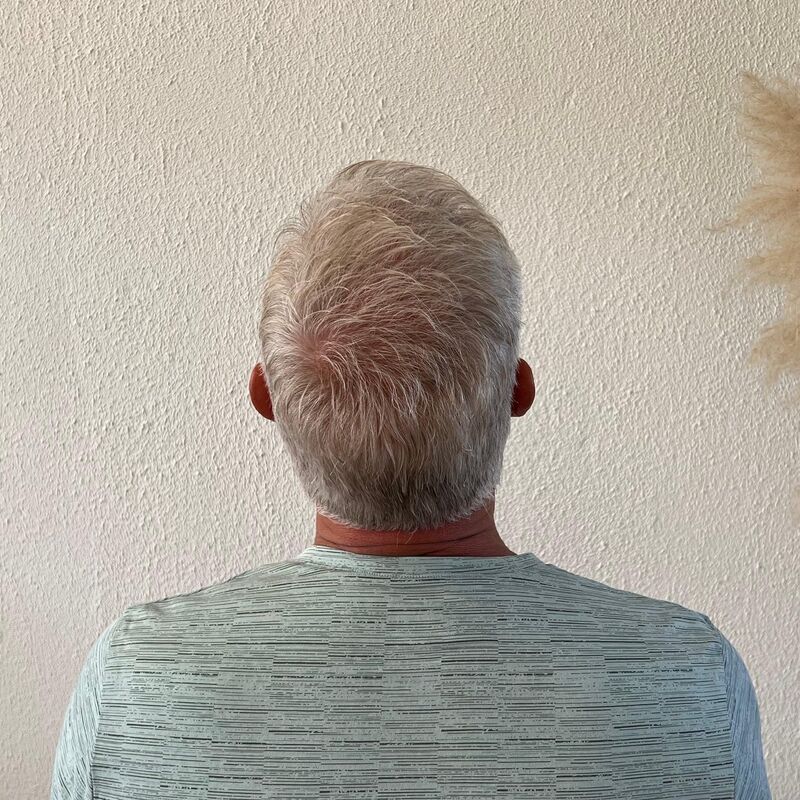 Haartransplantatie ook voor mensen boven de 60