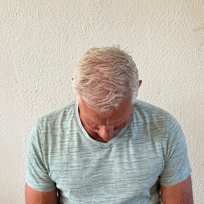 Haartransplantatie ook voor mensen boven de 60