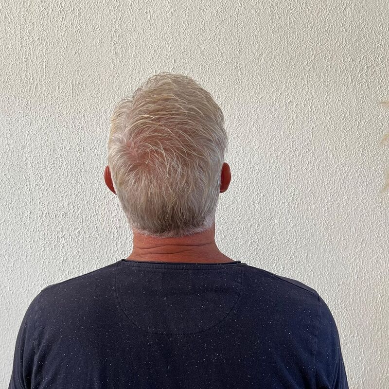 Haartransplantatie ook voor mensen boven de 60