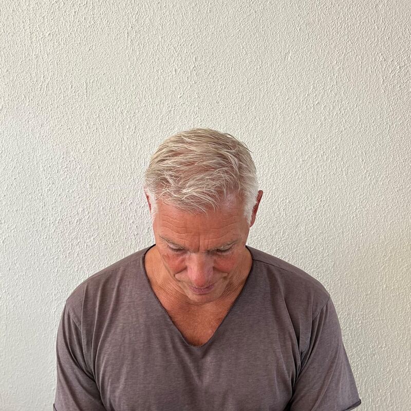 Haartransplantatie ook voor mensen boven de 60