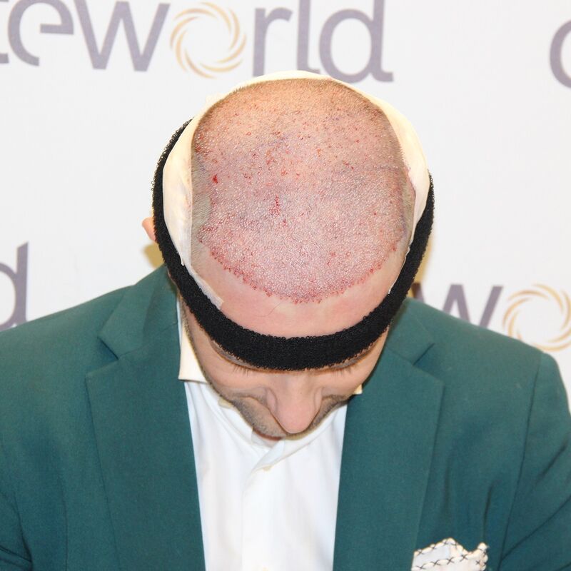 Jorrit stoorde zich al jaren aan die terugtrekkende haarlijn