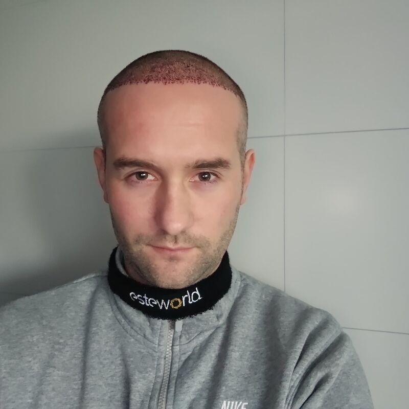 Jorrit stoorde zich al jaren aan die terugtrekkende haarlijn