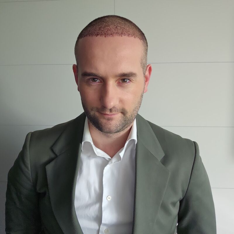 Jorrit stoorde zich al jaren aan die terugtrekkende haarlijn