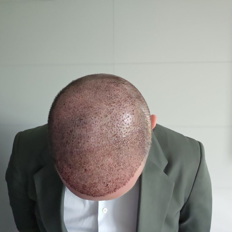 Jorrit stoorde zich al jaren aan die terugtrekkende haarlijn