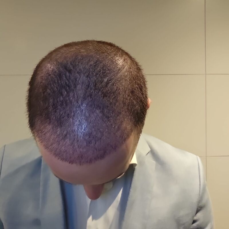 Jorrit stoorde zich al jaren aan die terugtrekkende haarlijn