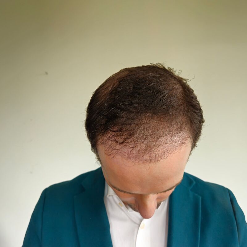 Jorrit stoorde zich al jaren aan die terugtrekkende haarlijn