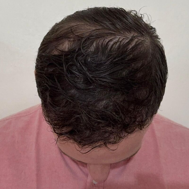 Jorrit stoorde zich al jaren aan die terugtrekkende haarlijn