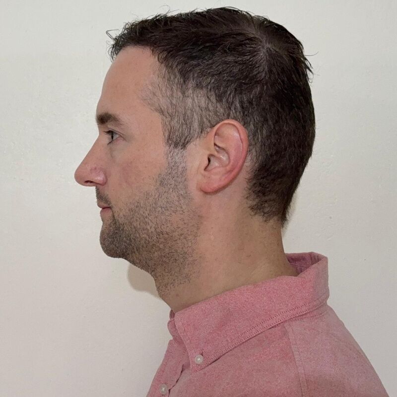 Jorrit stoorde zich al jaren aan die terugtrekkende haarlijn