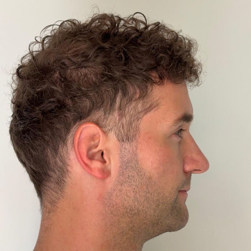 Jorrit stoorde zich al jaren aan die terugtrekkende haarlijn