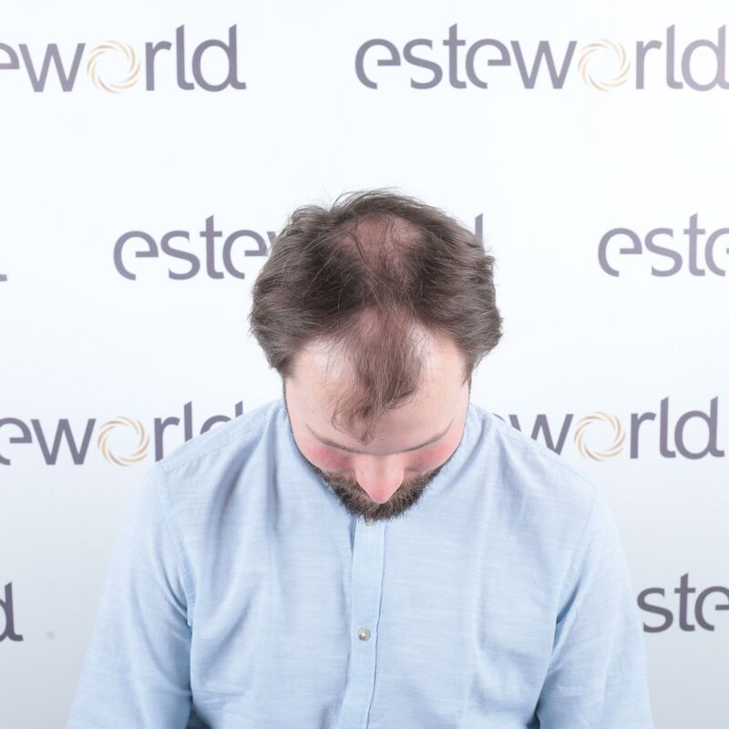 Niels, maak je geen zorgen wat mensen na de haartransplantatie zeggen