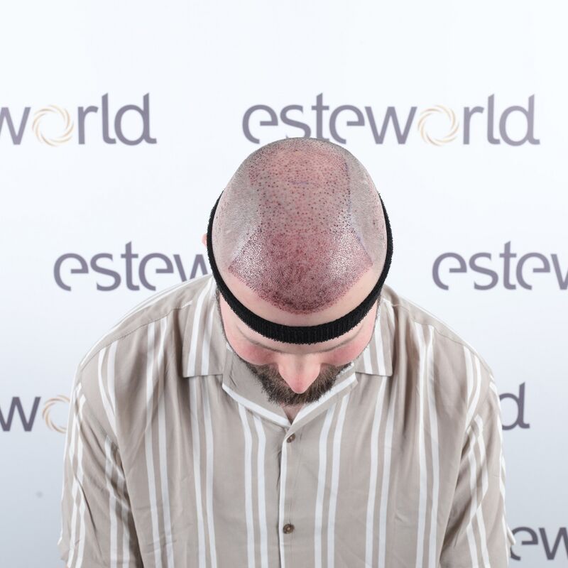 Niels, maak je geen zorgen wat mensen na de haartransplantatie zeggen