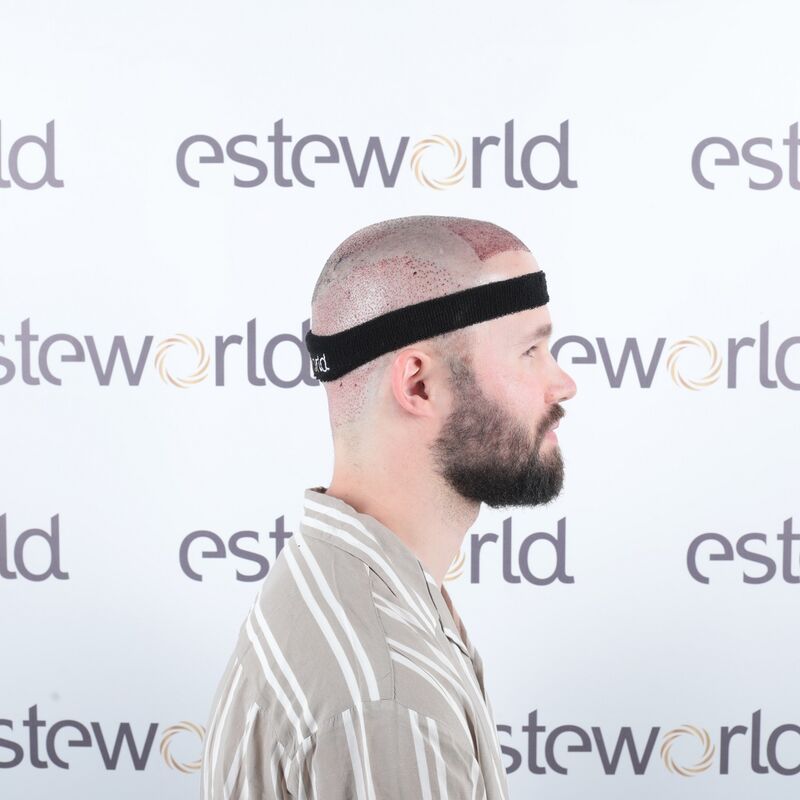Niels, maak je geen zorgen wat mensen na de haartransplantatie zeggen