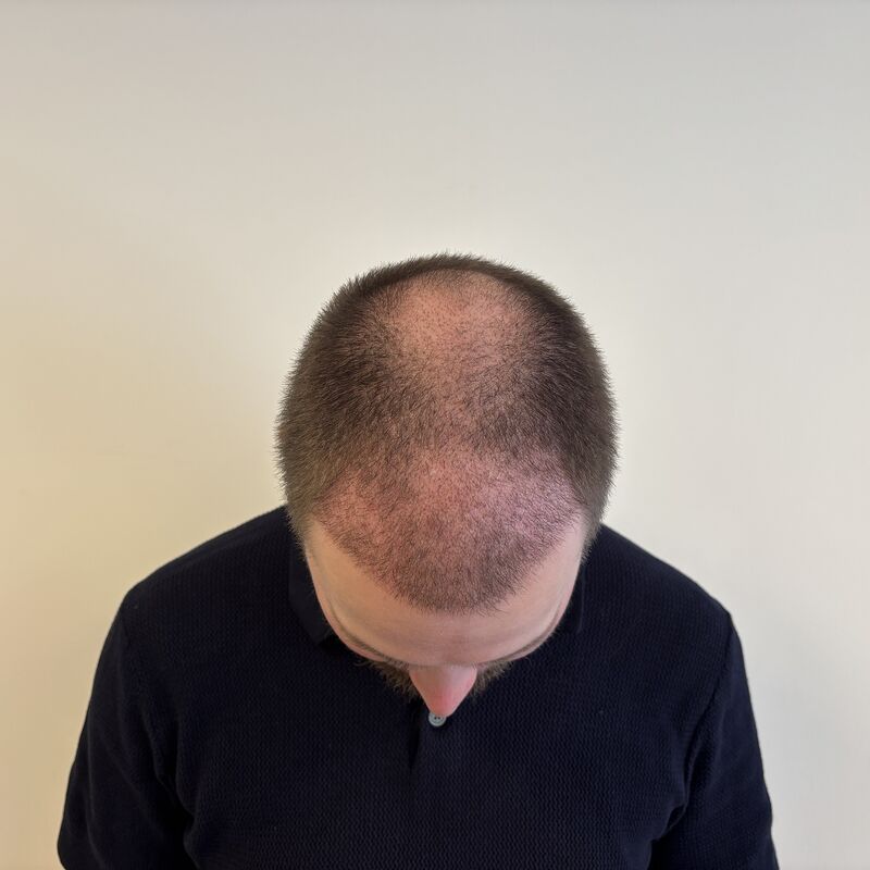 Niels, maak je geen zorgen wat mensen na de haartransplantatie zeggen