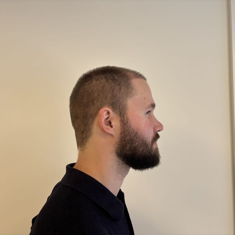 Niels, maak je geen zorgen wat mensen na de haartransplantatie zeggen