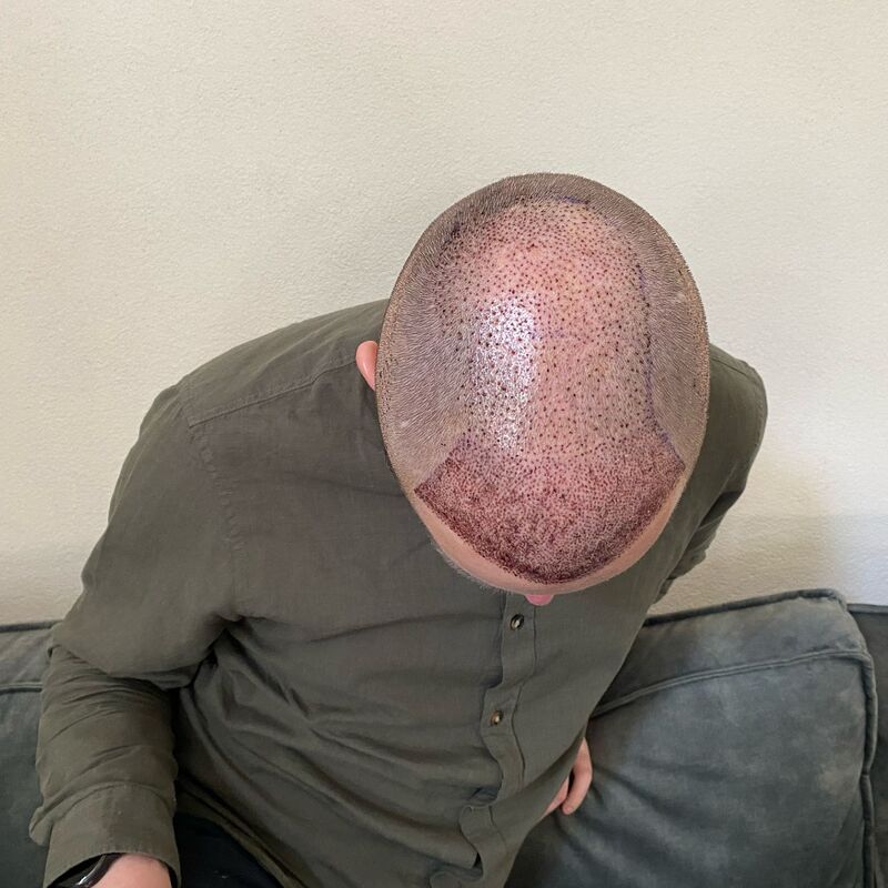 Niels, maak je geen zorgen wat mensen na de haartransplantatie zeggen