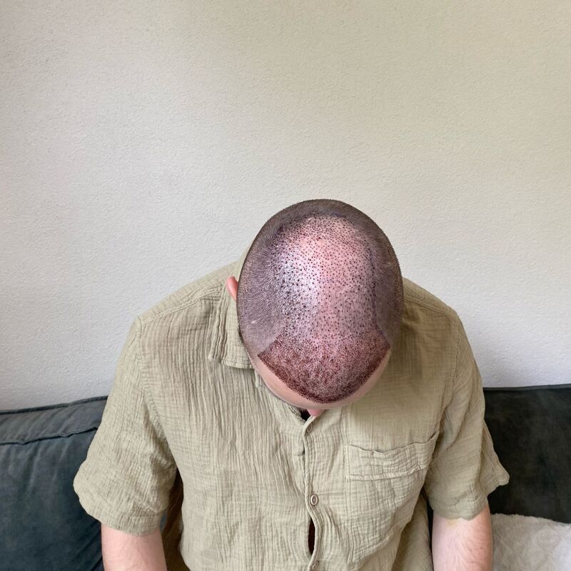 Niels, maak je geen zorgen wat mensen na de haartransplantatie zeggen