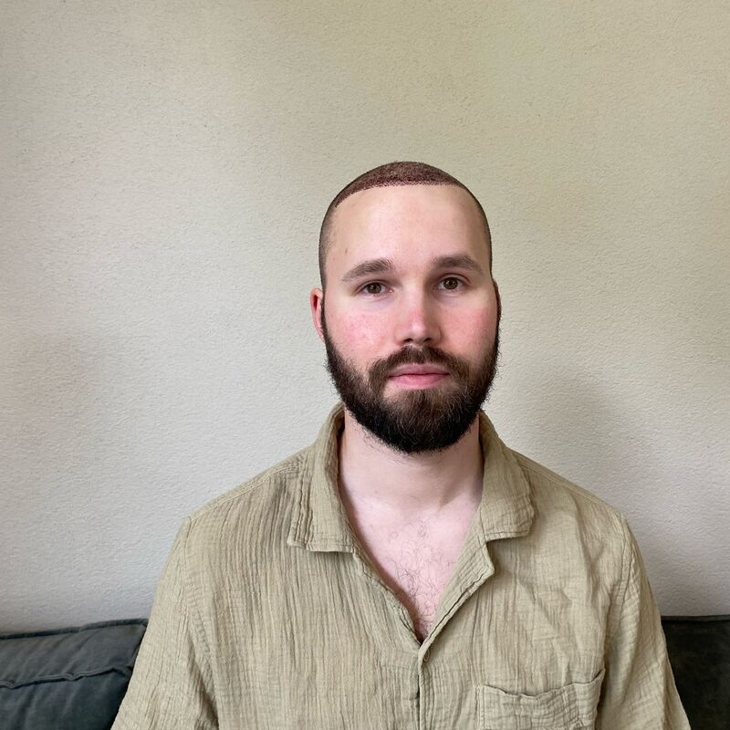 Niels, maak je geen zorgen wat mensen na de haartransplantatie zeggen