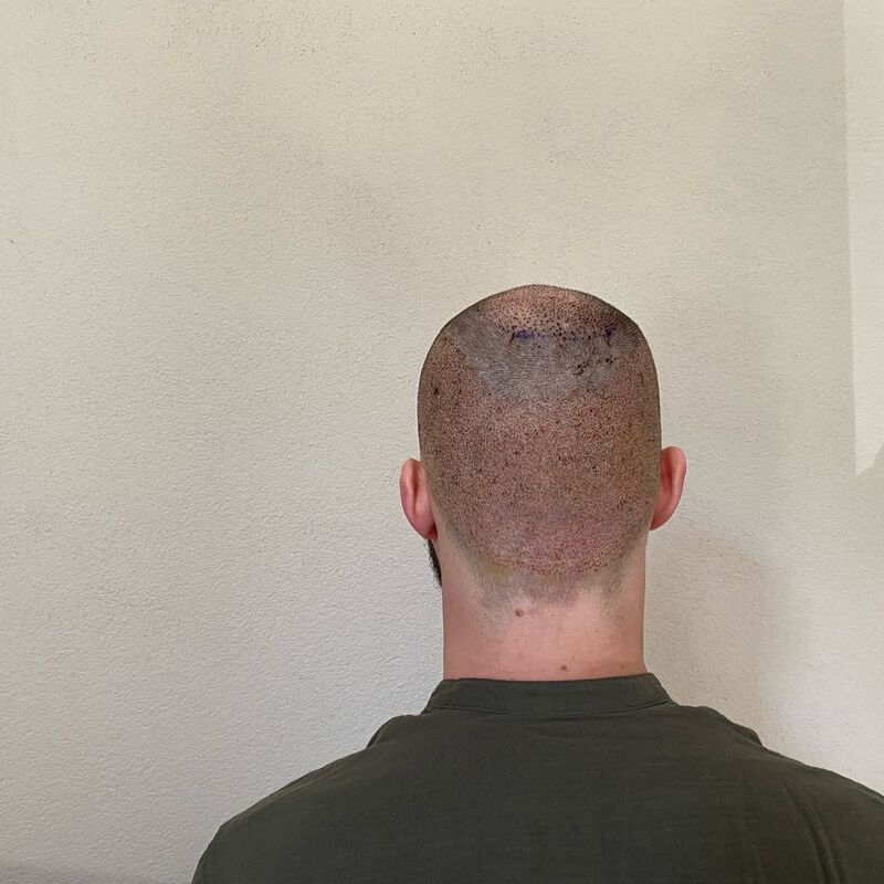 Niels, maak je geen zorgen wat mensen na de haartransplantatie zeggen