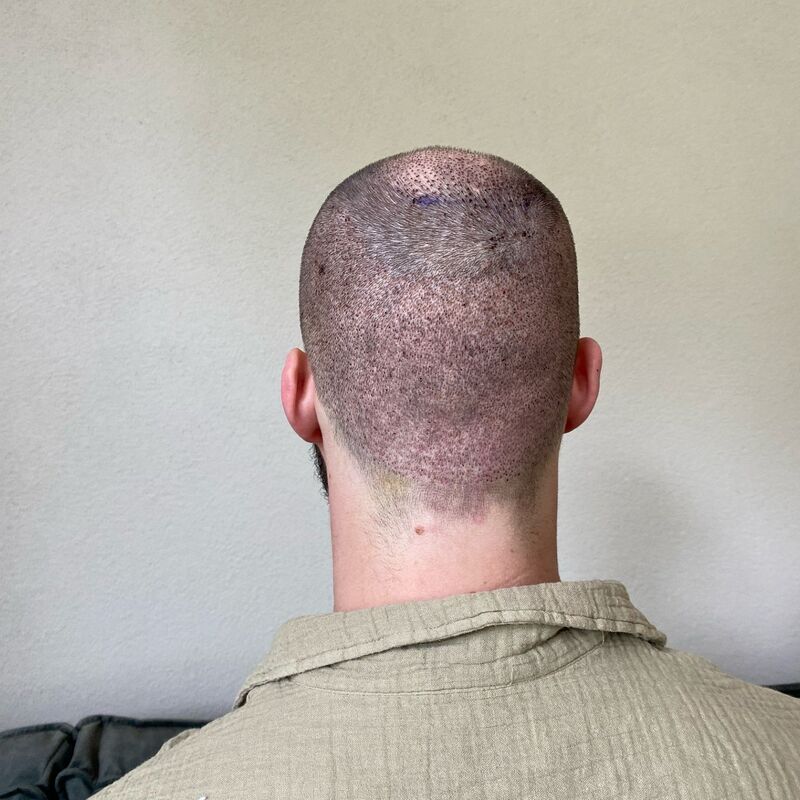 Niels, maak je geen zorgen wat mensen na de haartransplantatie zeggen