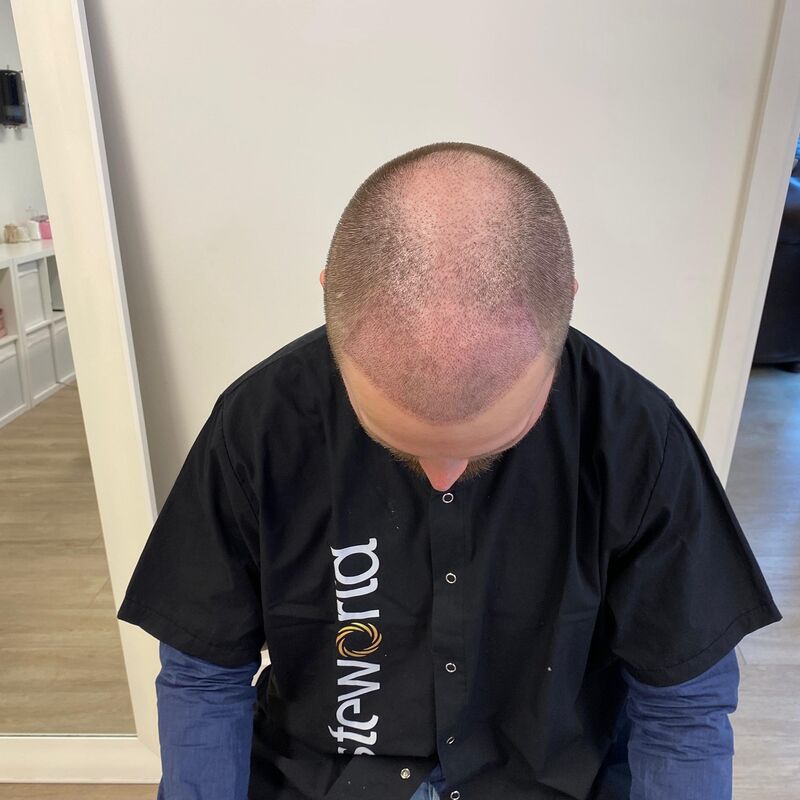 Niels, maak je geen zorgen wat mensen na de haartransplantatie zeggen
