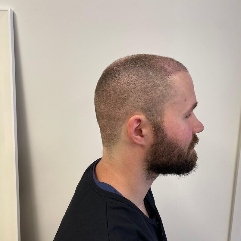 Niels, maak je geen zorgen wat mensen na de haartransplantatie zeggen