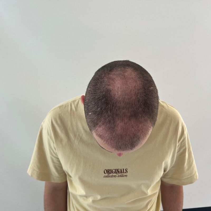 Niels, maak je geen zorgen wat mensen na de haartransplantatie zeggen