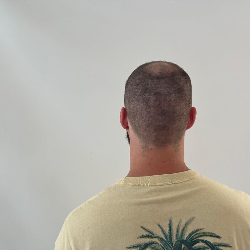 Niels, maak je geen zorgen wat mensen na de haartransplantatie zeggen