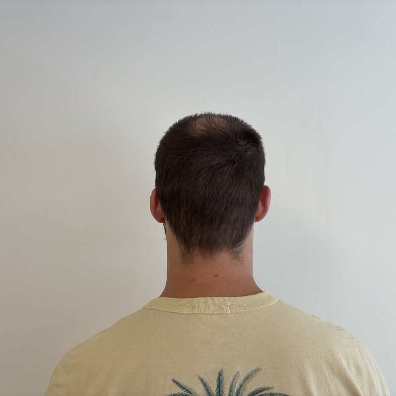 Niels, maak je geen zorgen wat mensen na de haartransplantatie zeggen