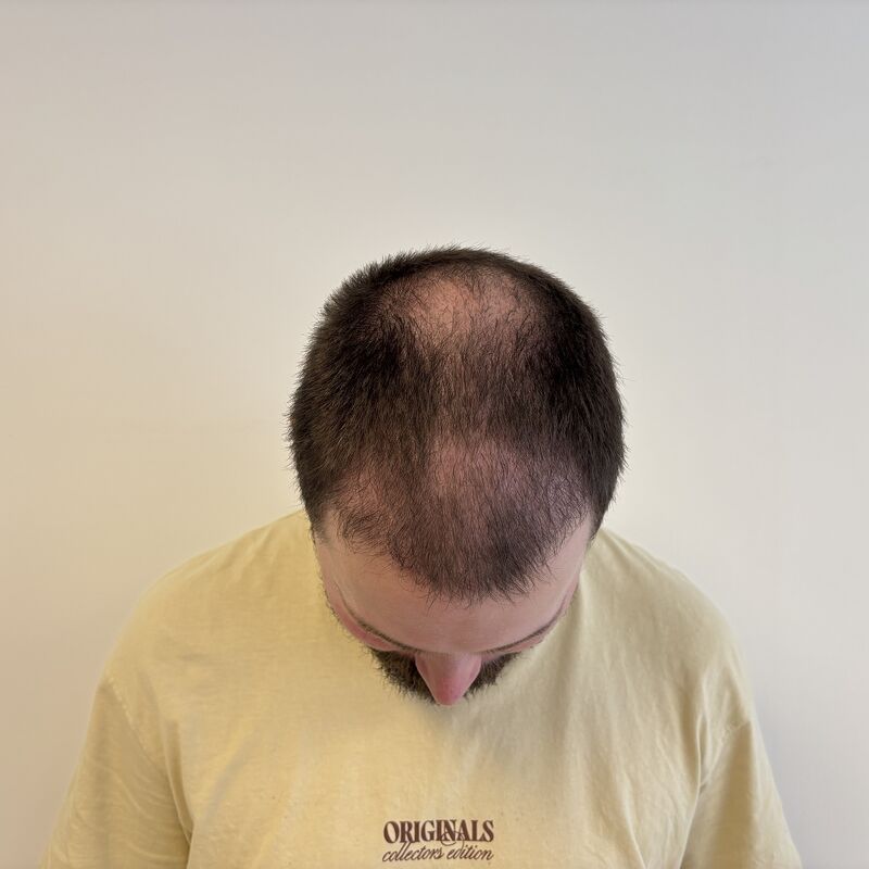 Niels, maak je geen zorgen wat mensen na de haartransplantatie zeggen
