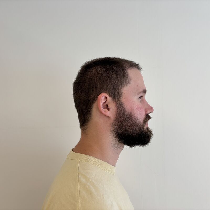Niels, maak je geen zorgen wat mensen na de haartransplantatie zeggen