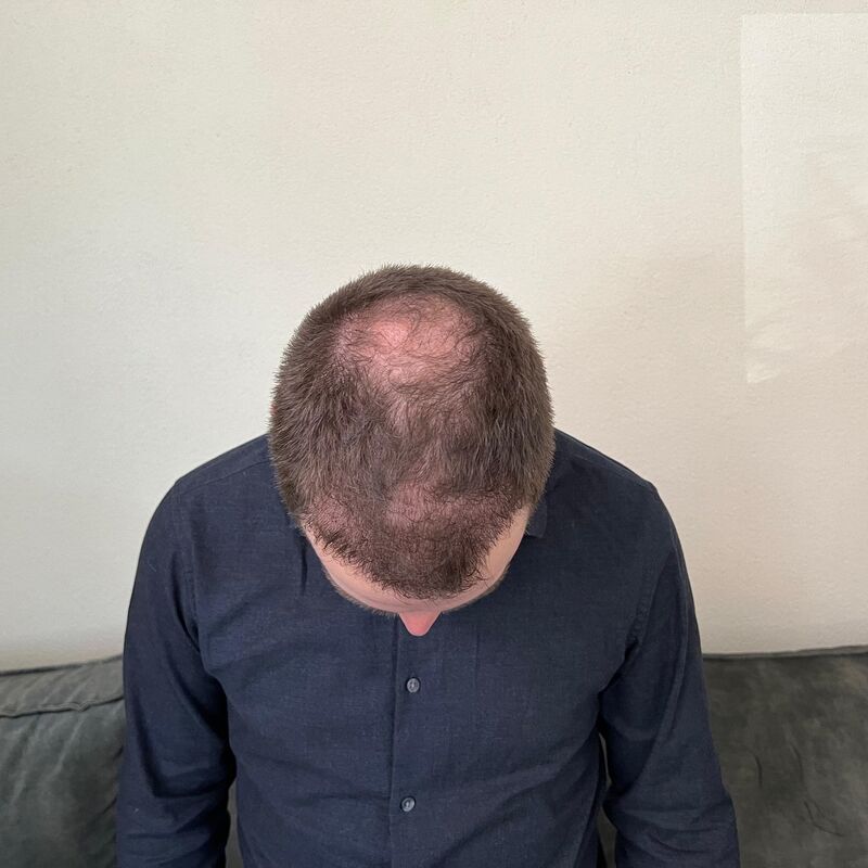 Niels, maak je geen zorgen wat mensen na de haartransplantatie zeggen