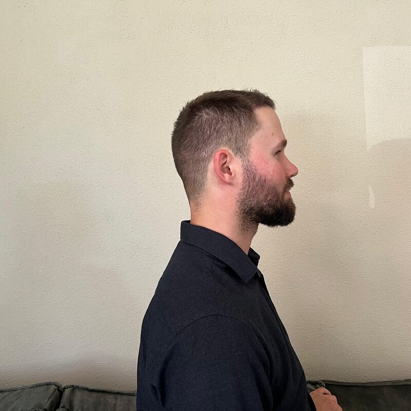 Niels, maak je geen zorgen wat mensen na de haartransplantatie zeggen