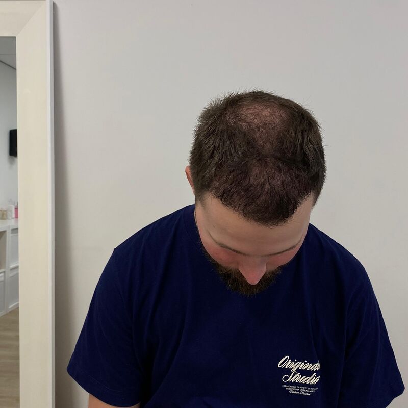 Niels, maak je geen zorgen wat mensen na de haartransplantatie zeggen