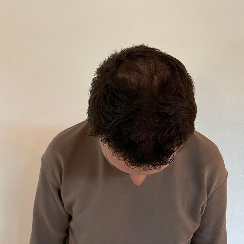 Niels, maak je geen zorgen wat mensen na de haartransplantatie zeggen