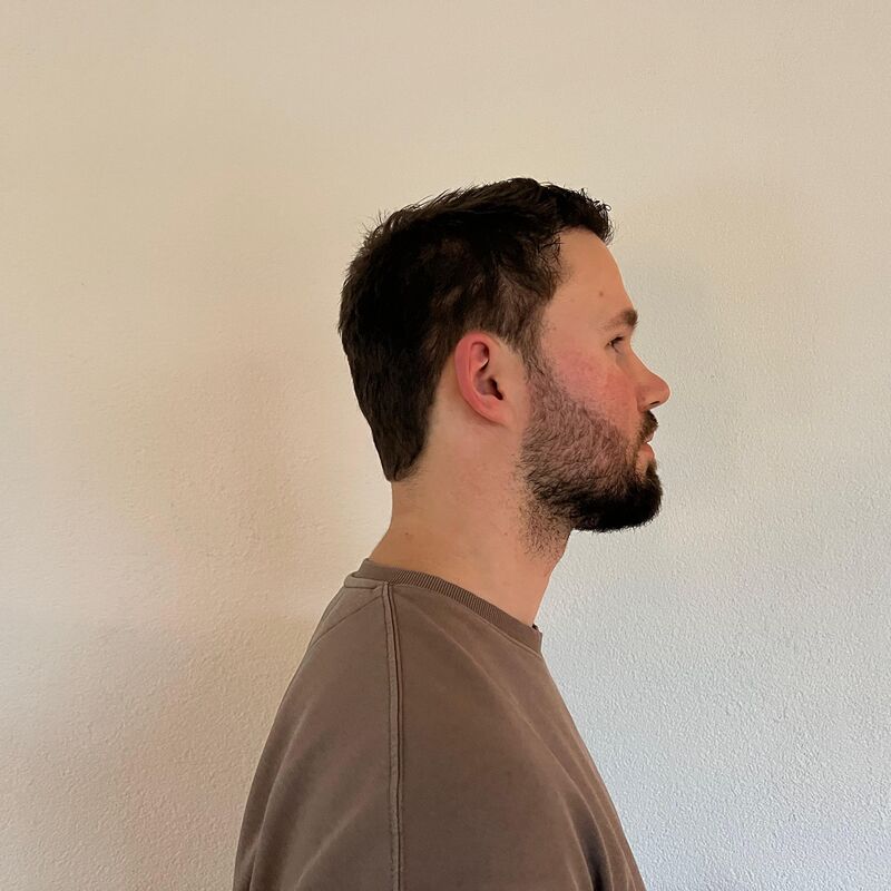 Niels, maak je geen zorgen wat mensen na de haartransplantatie zeggen