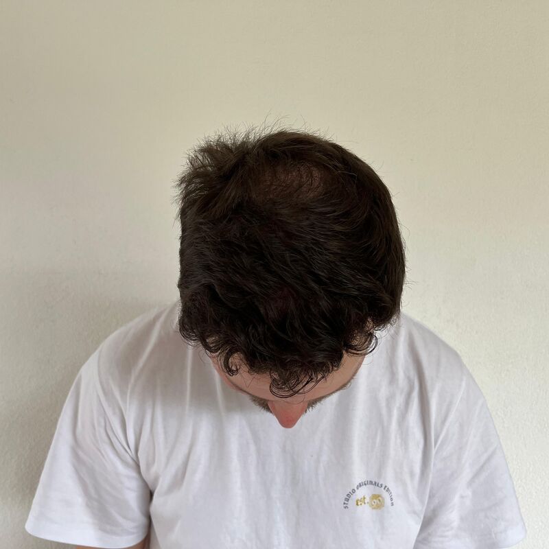 Niels, maak je geen zorgen wat mensen na de haartransplantatie zeggen